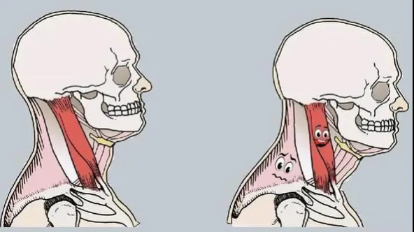 How To Correct Anterior Neck Tilt?